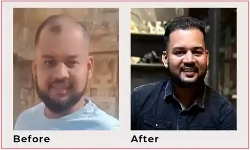 hair transplant results