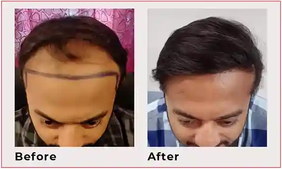 hair transplant results