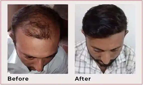 hair transplant results
