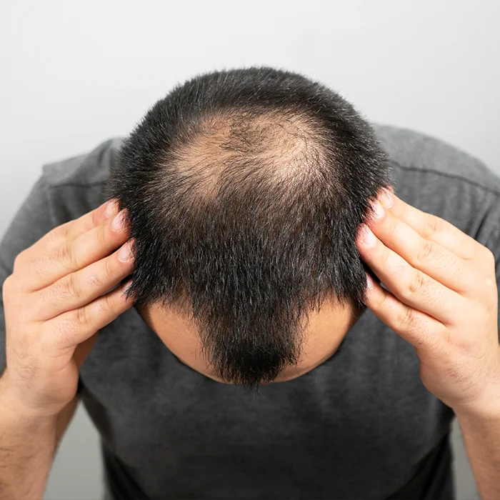 Hair loss Treatment